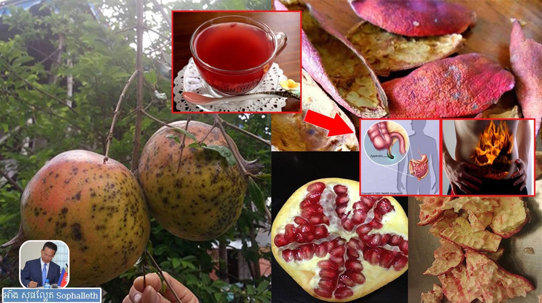 » ពិតជាអស្ចារ្យមែន! ព្យាបាលរលាកខ្នែងពោះវៀន រាកមួលប្រើពេល៥ម៉ោង  ហើយរលាកក្រពះ ពោះវៀនតែ ៧ថ្ងៃ នឹងជាដាច់ | អ៊ាង សុផល្លែត