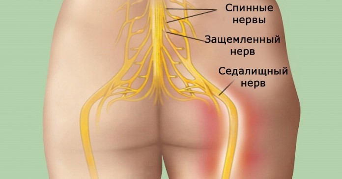 Попрощайтесь с болью в спине! Достижение успеха в 95 % случаев!